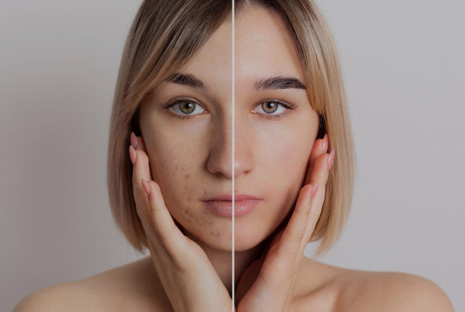 Before and after comparison of a woman's face with visible skin improvement.