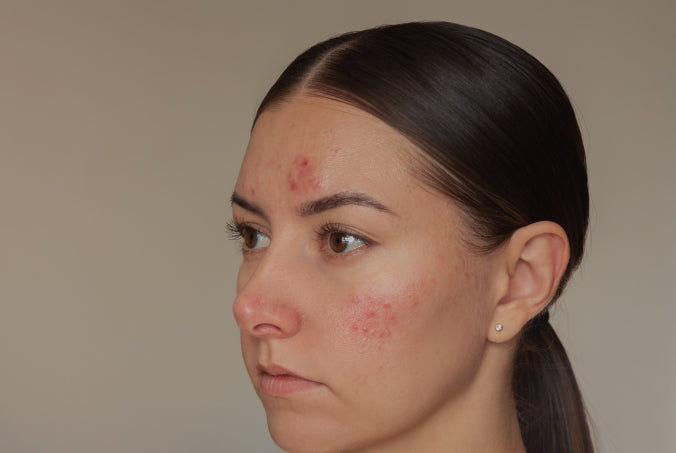 Woman with acne on her face against a neutral background