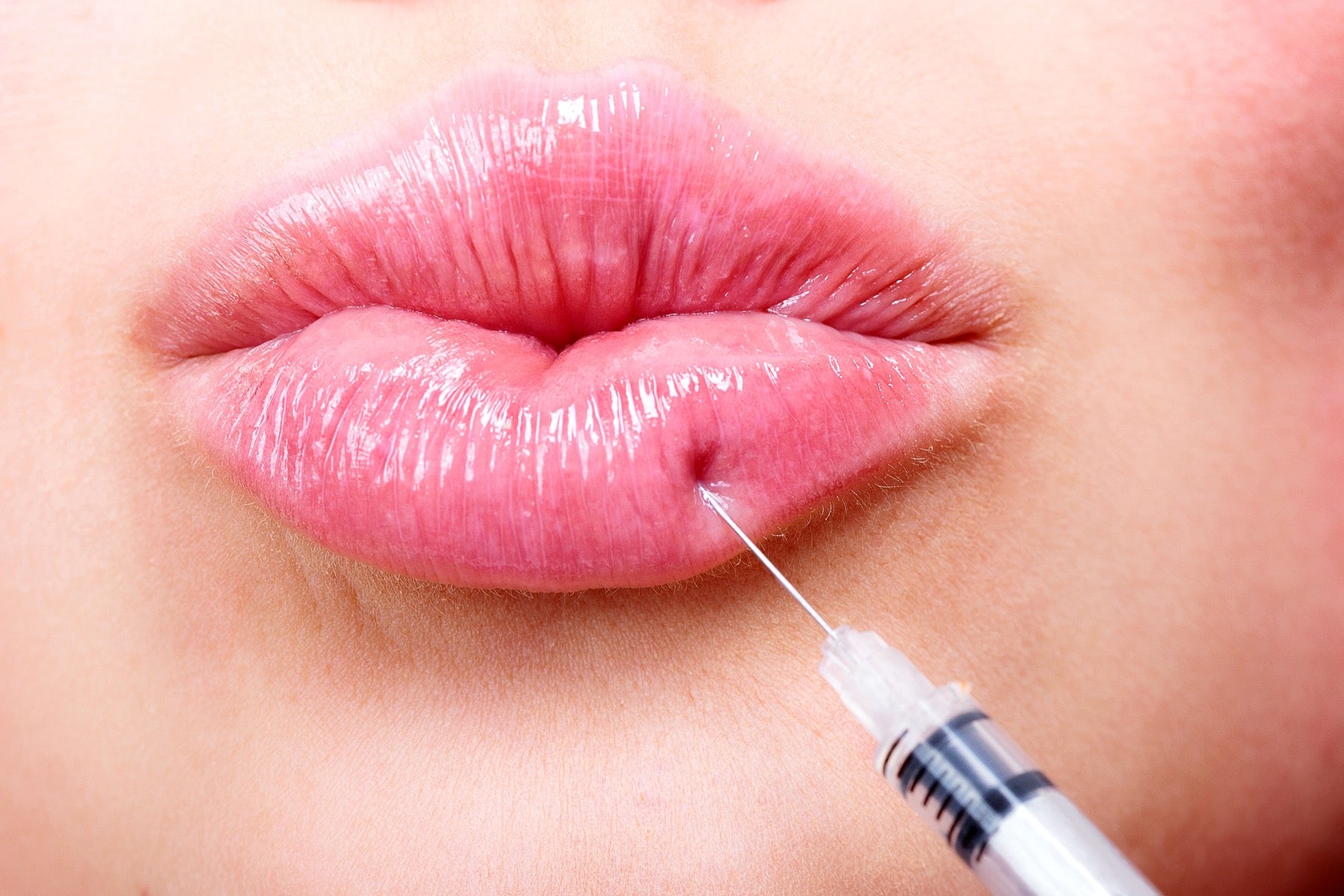 Close-up of a person receiving lip filler injection with a syringe.