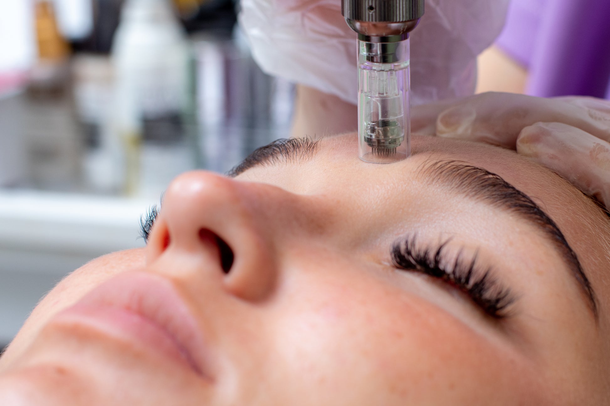 Microneedling treatment on girl face