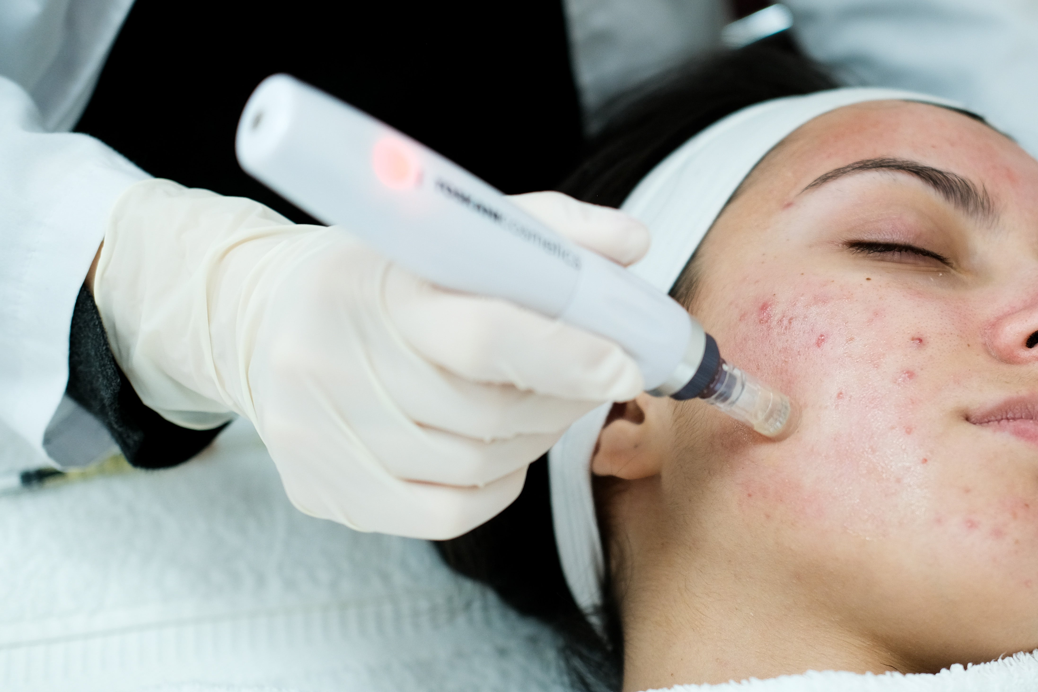 girl going through microneedling treatment 
