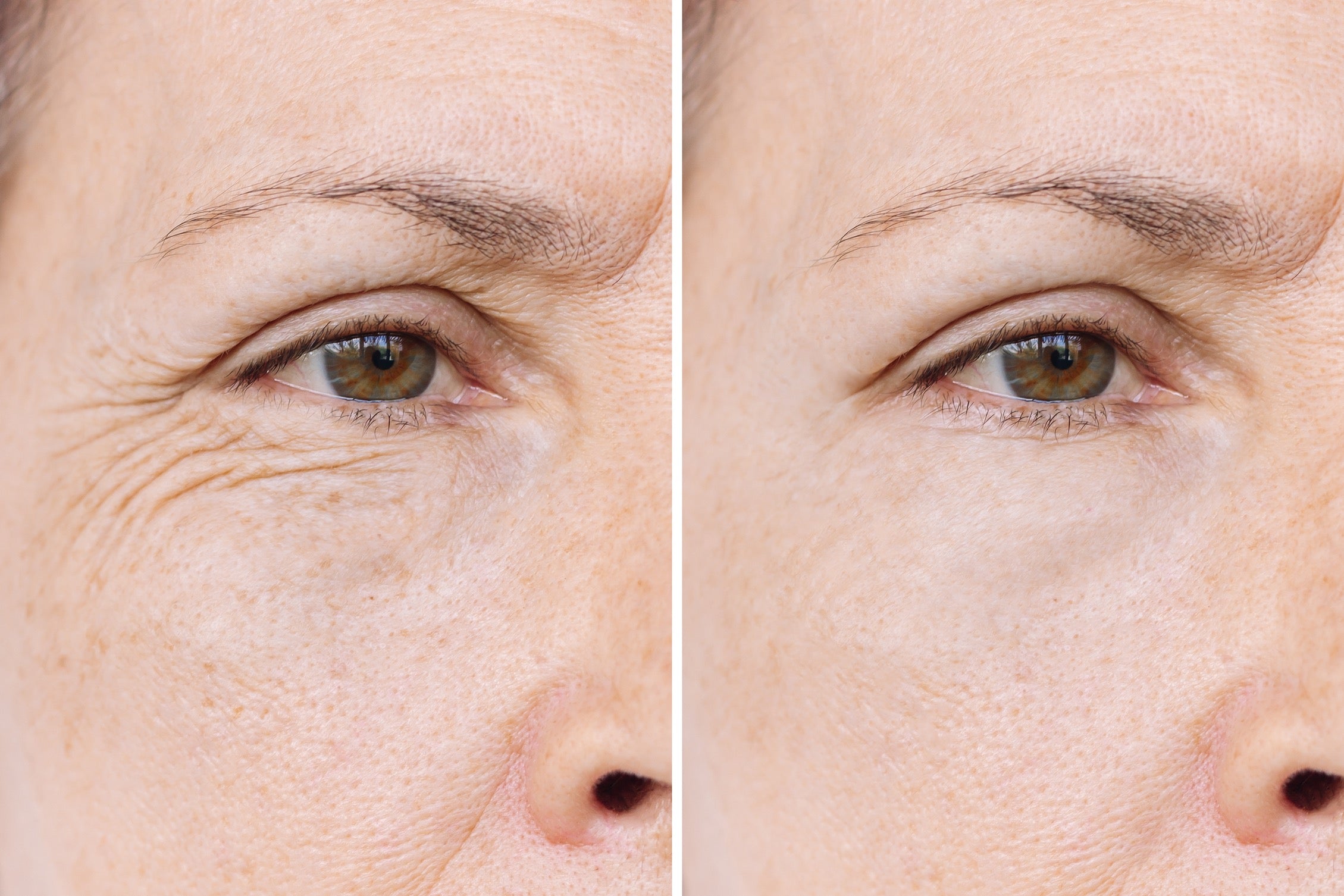 Before and after comparison of a woman's eye area with visible skin texture and wrinkles.