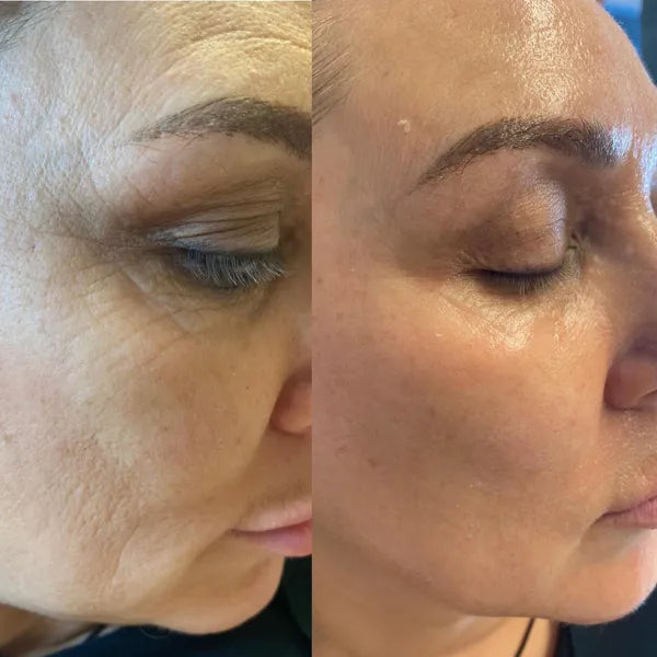 Before and after comparison of a woman's eye area with visible skin texture and lines.